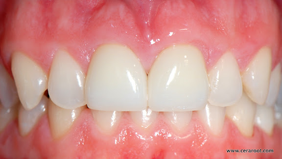 All ceramic implants provide a natural, more holistic solution to orthodontic care.