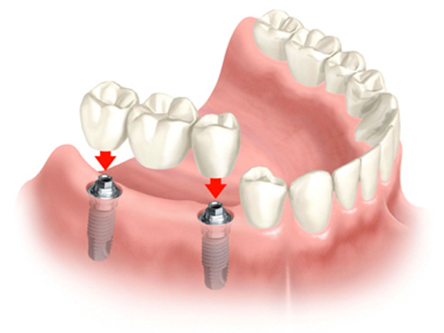 Dental bridges consist of two abutments flanking a pontic