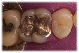 Amalgam fillings are a type of dental filling