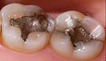 Onlays are fitted to accommodate the biting surface of a tooth and to restore function.