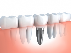 Dental implants can serve huge benefits for your overall health.