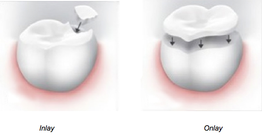 Inlays and Onlays are used to restore the function of a damaged filling.